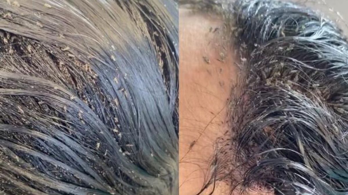 El vídeo viral de una niña totalmente plagada de piojos: tenía más de 15.000 insectos en su cabeza