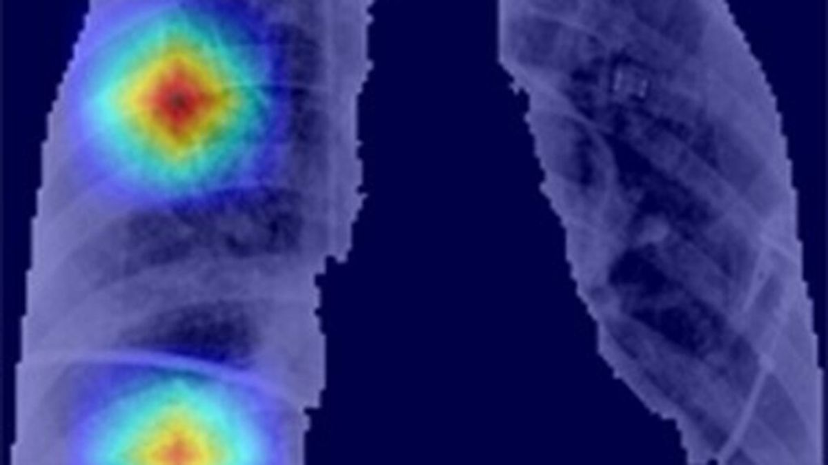 Resultados de segmentación automática de los pulmones e identificación de regiones de interés en paciente con covid-19.