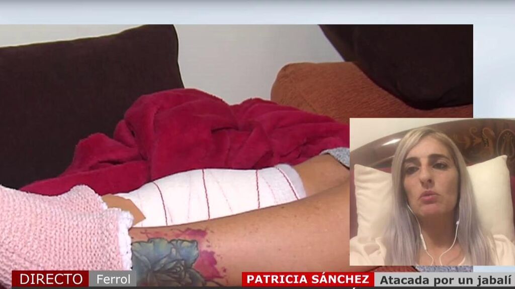 Patricia, atacada brutalmente por un jabalí: “Me tiró al suelo y empezó a comerme la pierna”