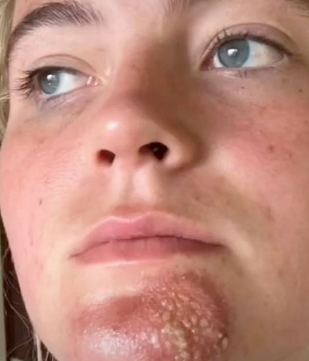 Una tiktoker comparte su desagradable infección en la barbilla tras besar a un hombre con barba