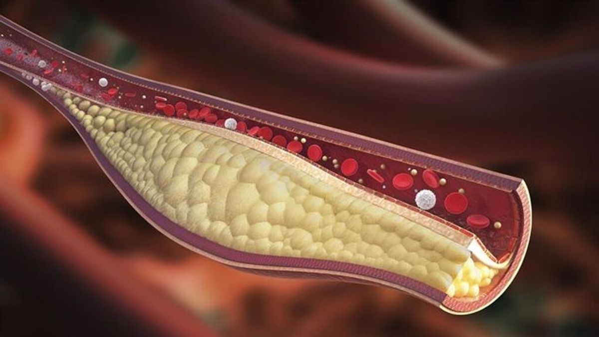 Xantomas o xantelasmas, qué son esas bolitas de grasa que aparecen en el cuerpo y qué indican de tu salud