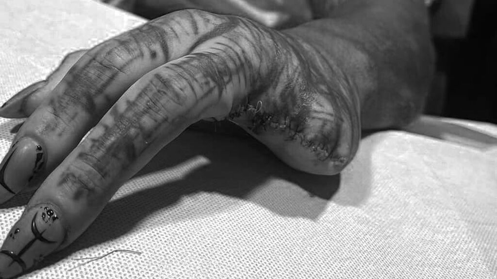 Anthony Loffredo, el 'alienígena negro', reaparece ahora con una 'garra' tras amputarse dos dedos