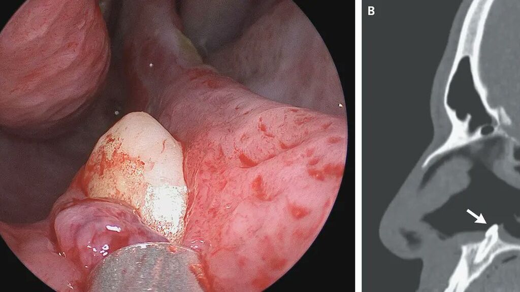 Se queja durante años de problemas para respirar y descubren que le había crecido un diente en la nariz