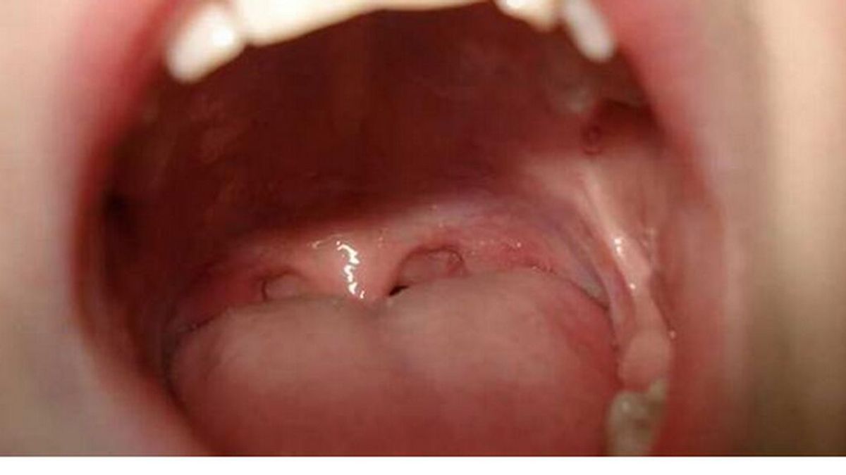 Indemnización por negligencia médica en Badalona: confundieron un cáncer de boca con una llaga