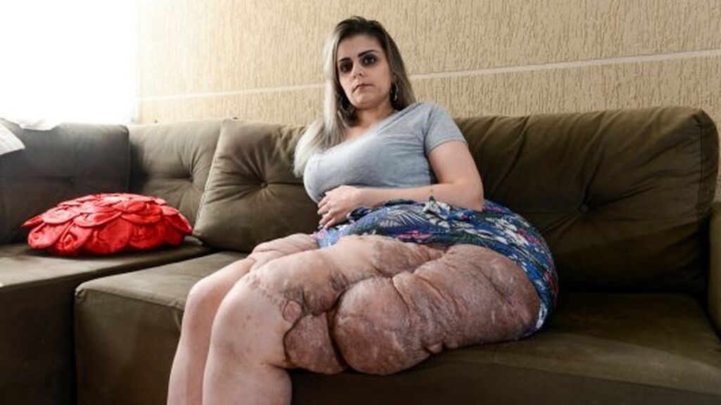 Le extirpan un tumor de 30 kilos que había crecido a causa de una enfermedad genética