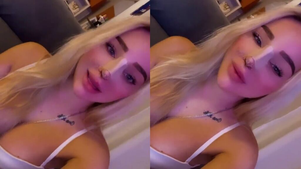 emmy-russ-rinoplastia