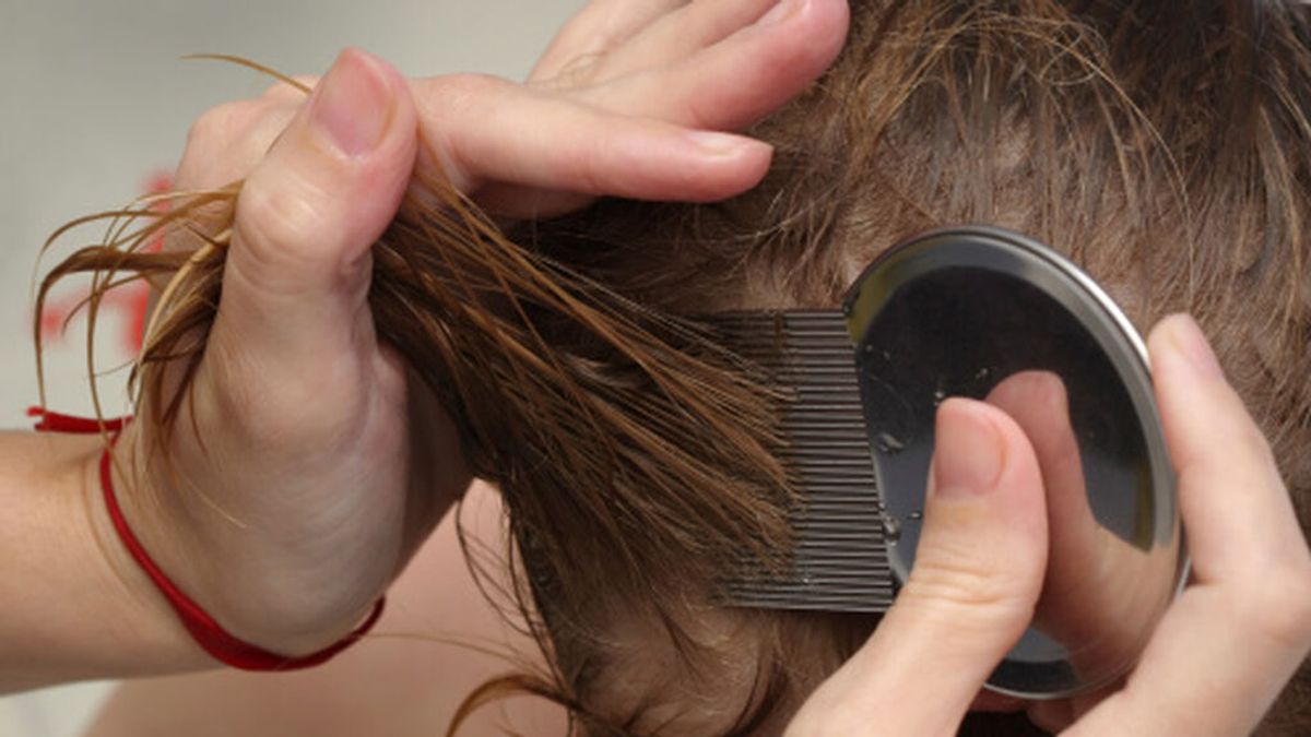 Una técnica comparte el peor caso de piojos que ha visto: el pelo de una niña se desprendía del cuero cabelludo
