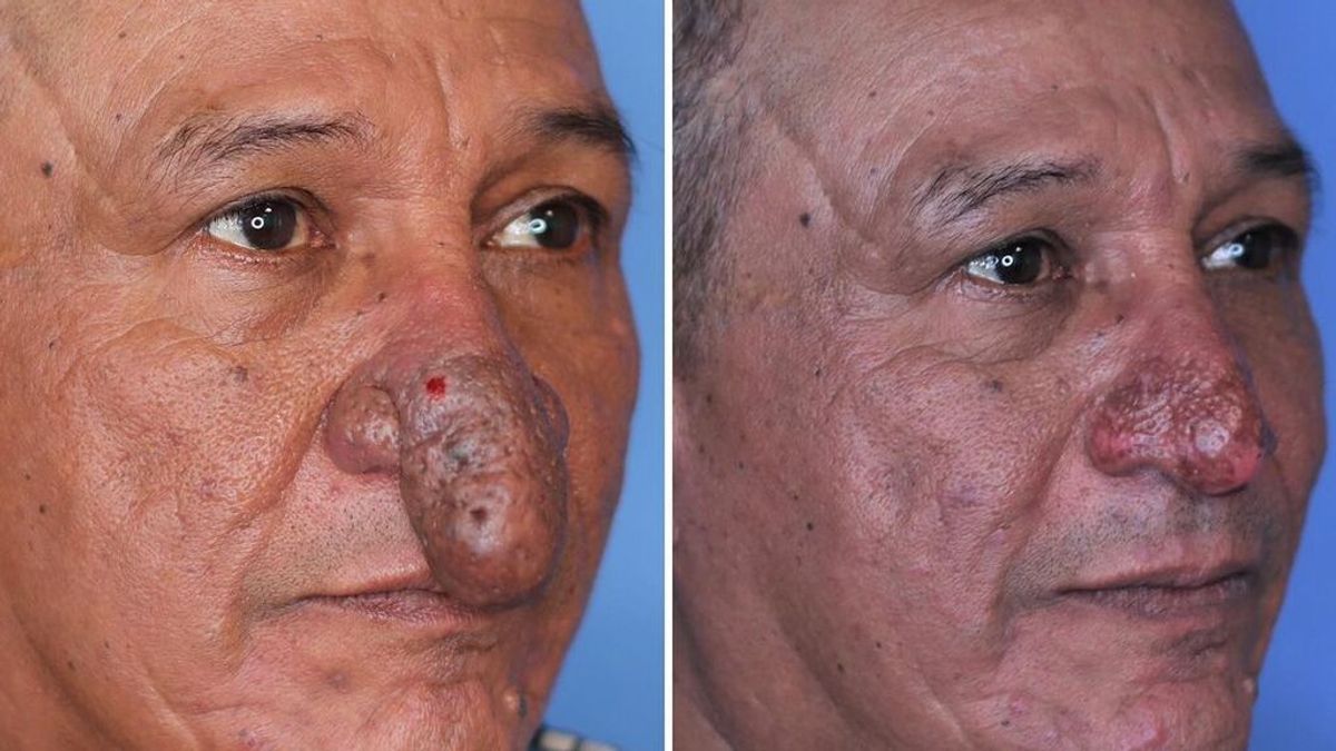 La operación estética a Conrado Ramos: un hombre que sufría rinofima, una rara enfermedad de la nariz