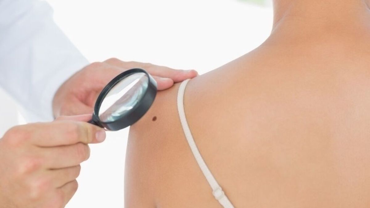 Crean la primera prueba para detectar el riesgo de propagación del melanoma