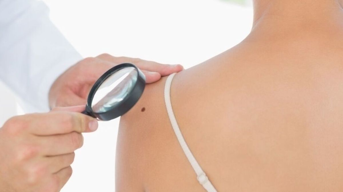 Crean la primera prueba para detectar el riesgo de propagación del melanoma Crean la primera prueba para detectar el riesgo de propagación del melanoma