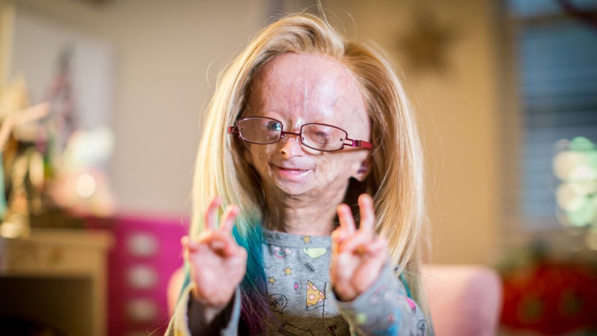 Muere con 15 años Adalia Rose, la 'youtuber' que envejecía más rápido por el síndrome de progeria