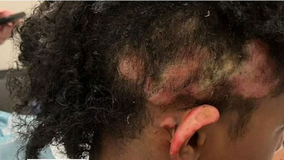 Una adolescente de 13 años le quema el pelo y una oreja a otro compañero en un instituto de EEUU