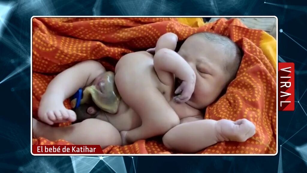 El bebé nacido con cuatro piernas y cuatro brazos enternece a Iker Jiménez