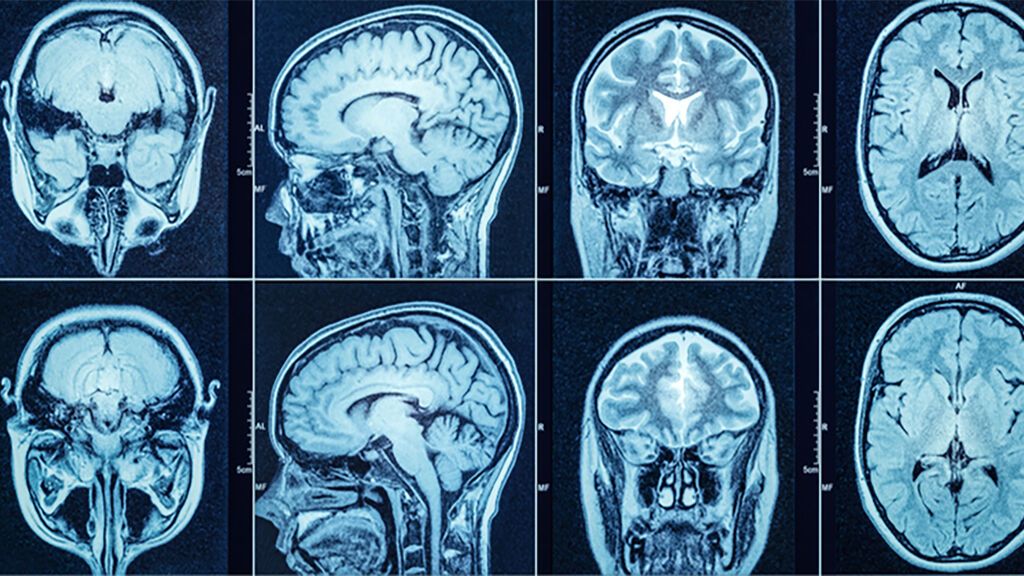 Un nuevo fármaco animales abre la esperanza a la curación de tumores cerebrales más agresivos