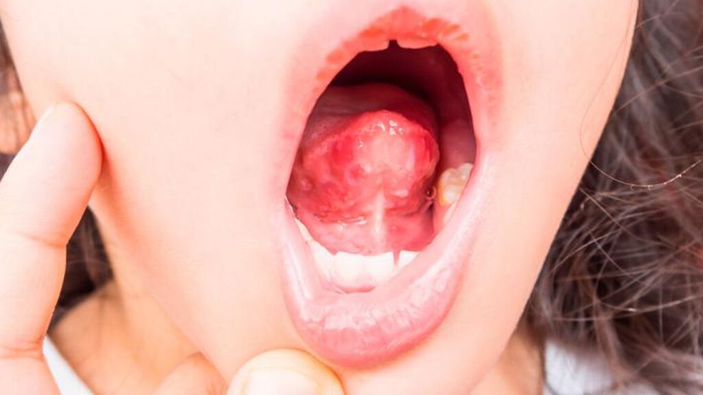 Esta enfermedad provocará unas heridas en la zona de la boca.