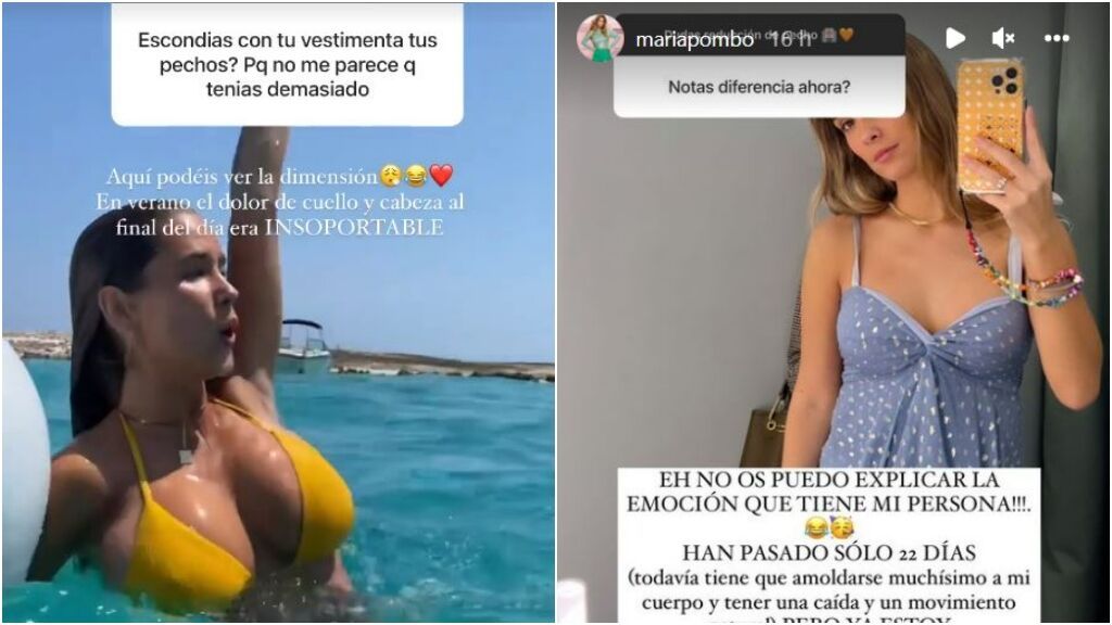 El antes y después de María Pombo tras su reducción de pecho