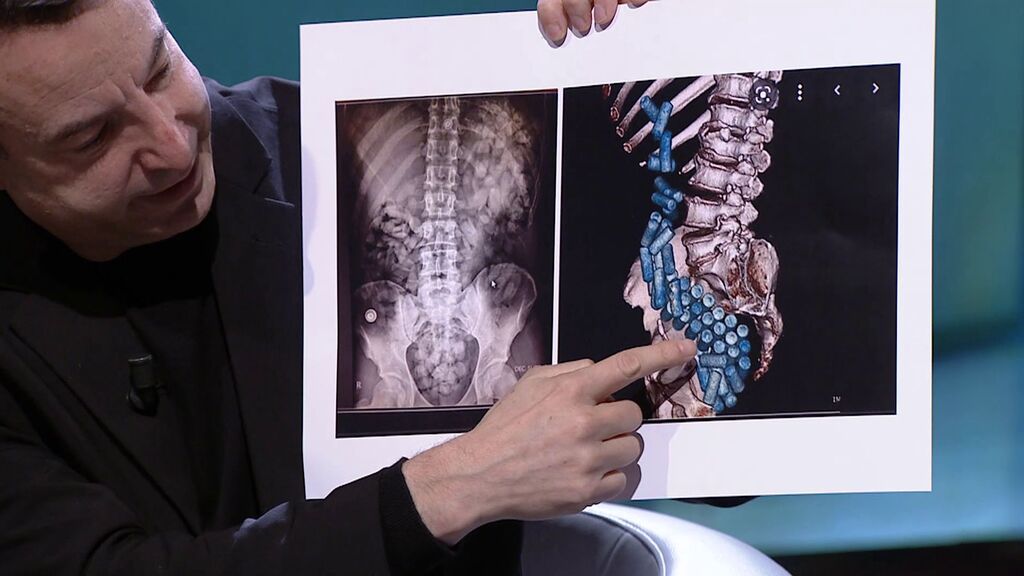 El doctor César Carballo muestra en televisión la radiografía de una ‘mula’
