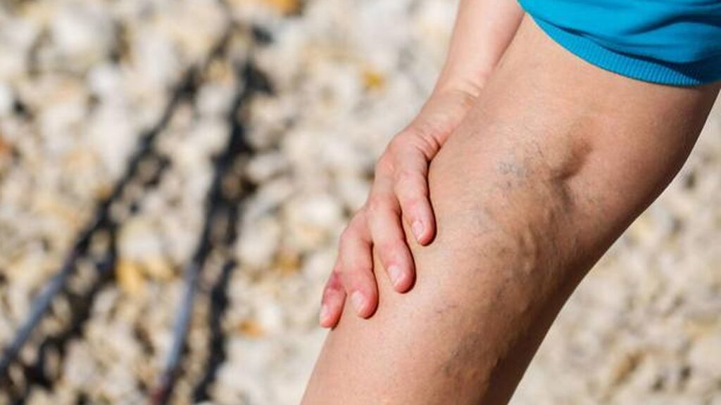 Estos son los trucos caseros para aliviar el dolor de las varices: de los masajes con aceites esenciales a la aplicación de frío y calor.