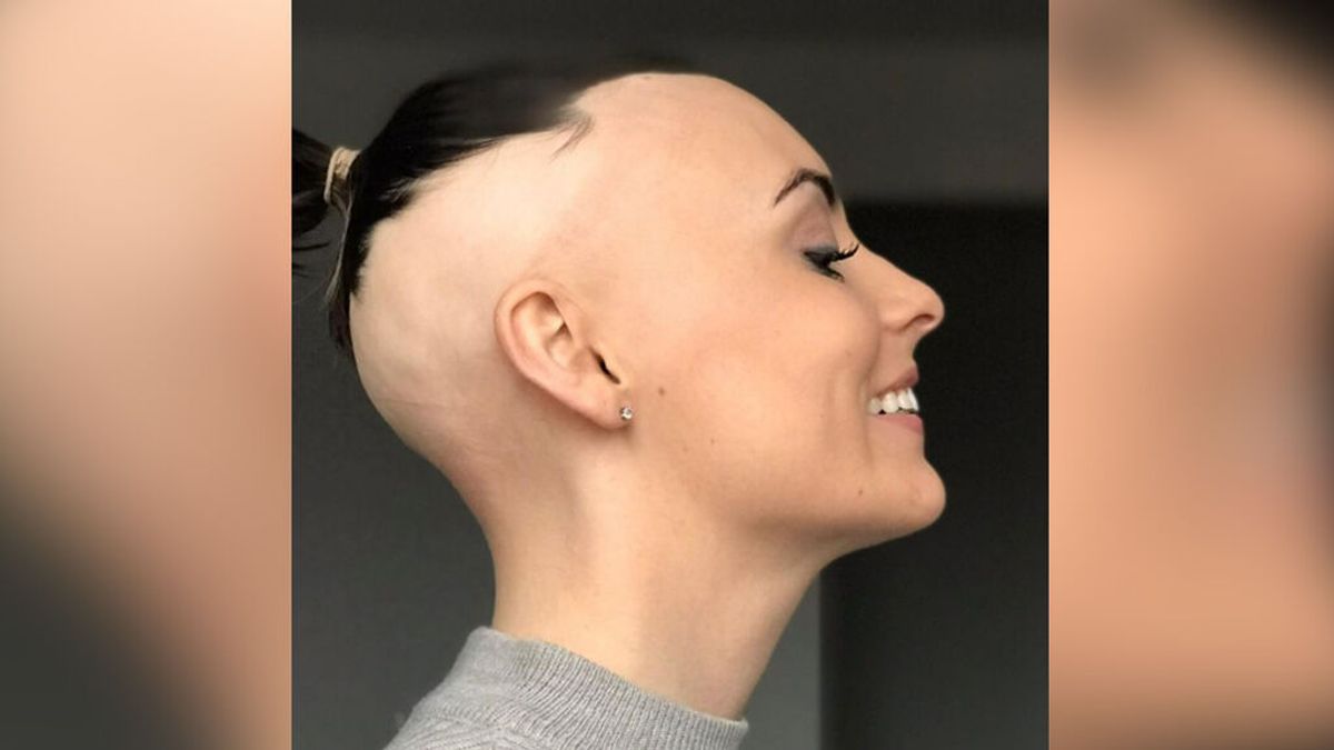 Una joven de 27 años pierde su cabello tras someterse a una citología para prevenir el cáncer de cuello de útero
