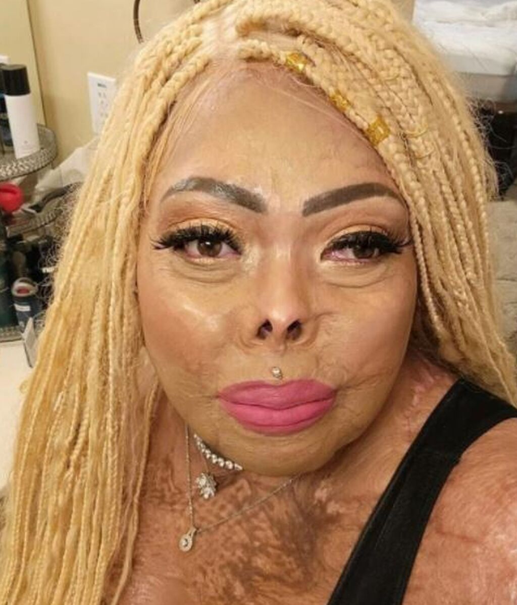 Tonya, una mujer que sufrió un accidente mientras celebraba una barbacoa