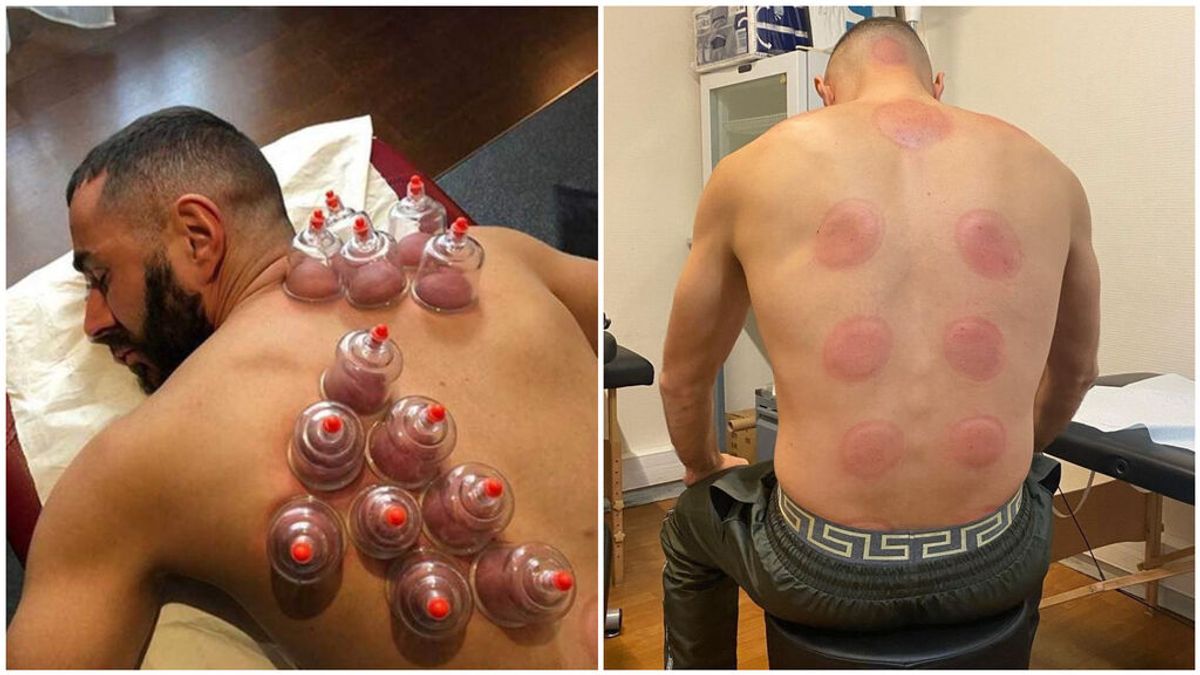 Así es el ‘cupping’, el método de Karim Benzemá para mantenerse en un estado de forma perfecto Así es el ‘cupping’, el método de Karim Benzemá para mantenerse en un estado de forma perfecto