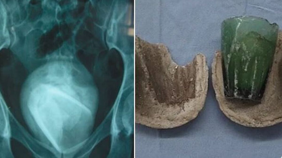 Los médicos encuentran un vaso atascado dentro de la vejiga de una mujer desde hace cuatro años