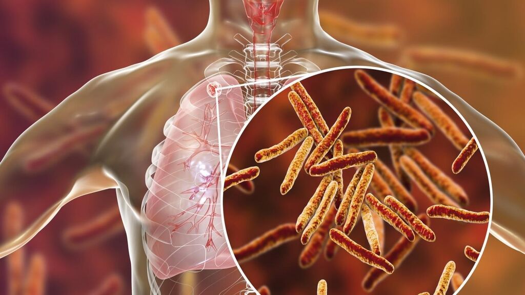 Las muertes por tuberculosis aumentan por primera vez en una década: la OMS exige más inversiones