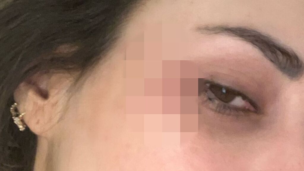 Cristina Porta muestra el herpes zóster oftálmico que le ha salido