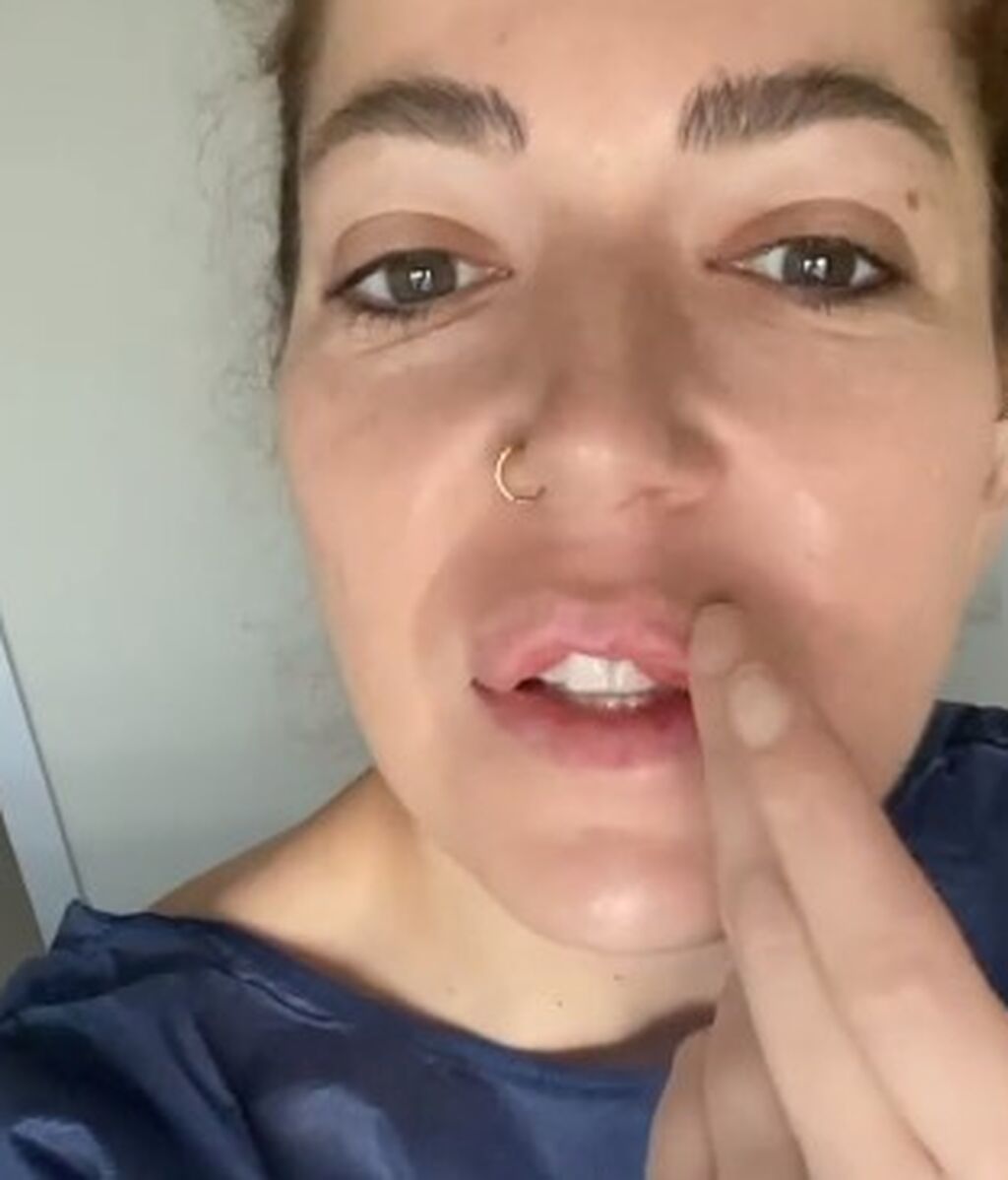 Sofía Cristo, explicando su queiloplastia en labios