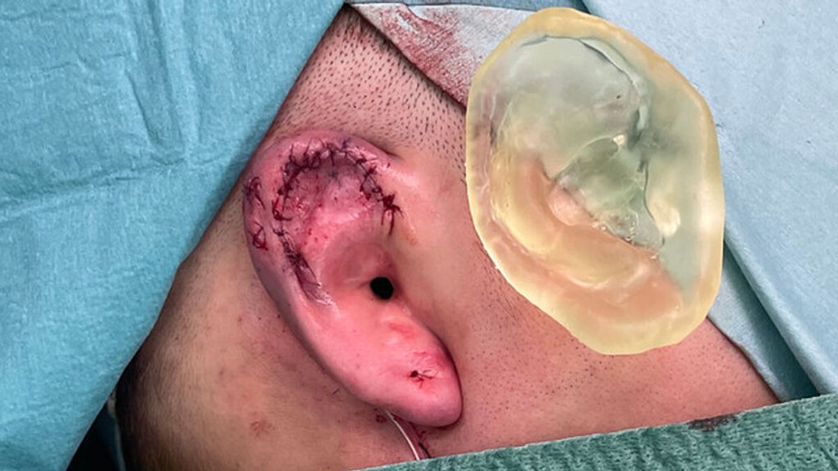 El Hospital de Sant Pau reconstruye la oreja de un paciente con tecnología 3D