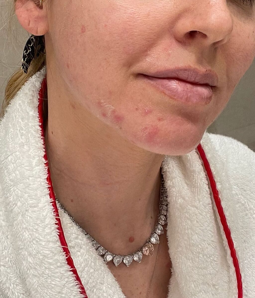 Chiara Ferragni ha sufrido un fuerte brote de acné