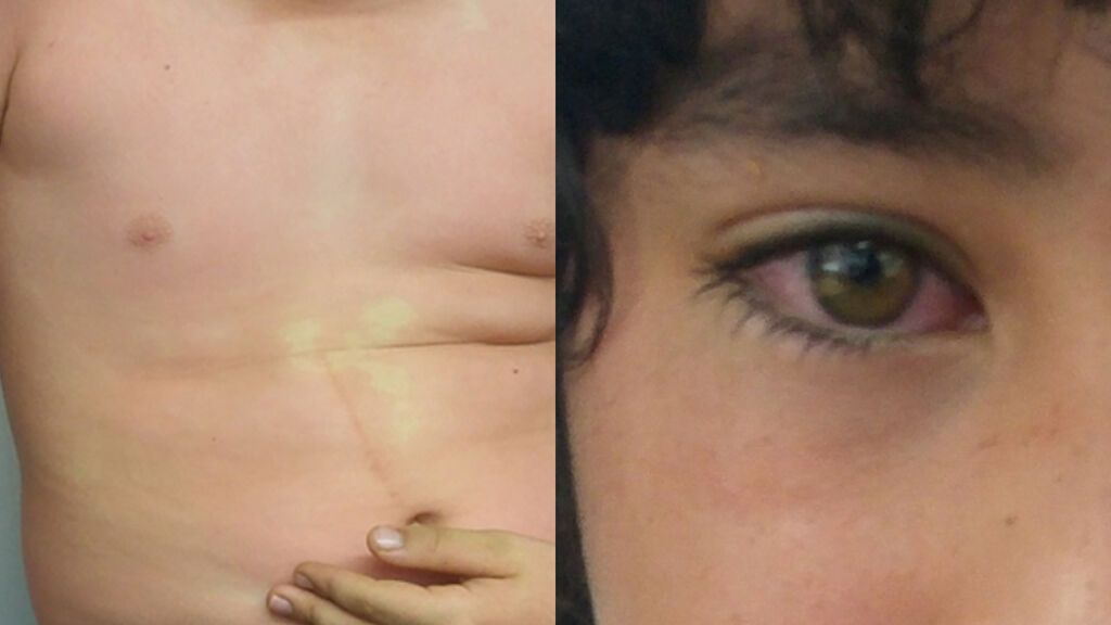 Un doctor filtra en Twitter las fotos de dos niños tras comer una lata de atún mal conservada