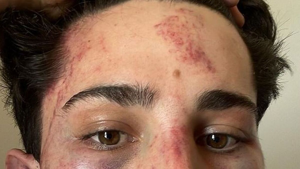 Un joven denuncia la brutal paliza que recibió en una discoteca de Valencia al grito de "maricón de mierda"