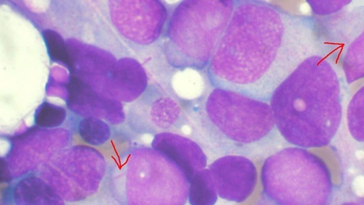 Un estudio sugiere que el componente genético no influye tanto en el cáncer como se pensaba Un estudio sugiere que el componente genético no influye tanto en el cáncer como se pensaba