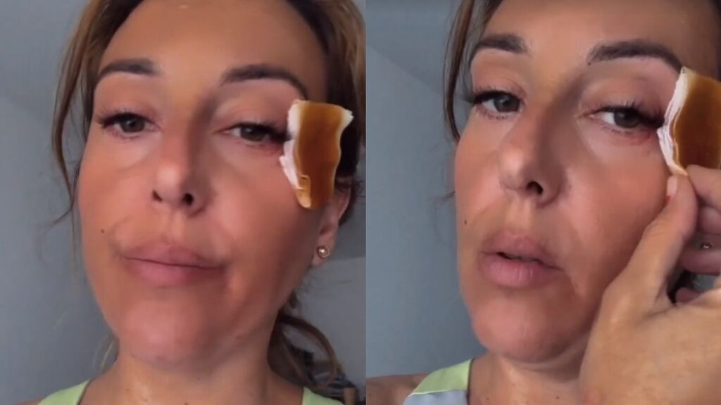 Julia Mejide enseña las secuelas de su aparatoso accidente