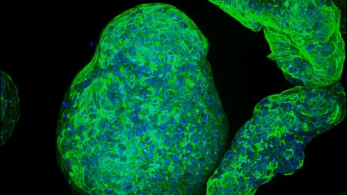 Virus contra el cáncer de páncreas avanzado Virus contra el cáncer de páncreas avanzado