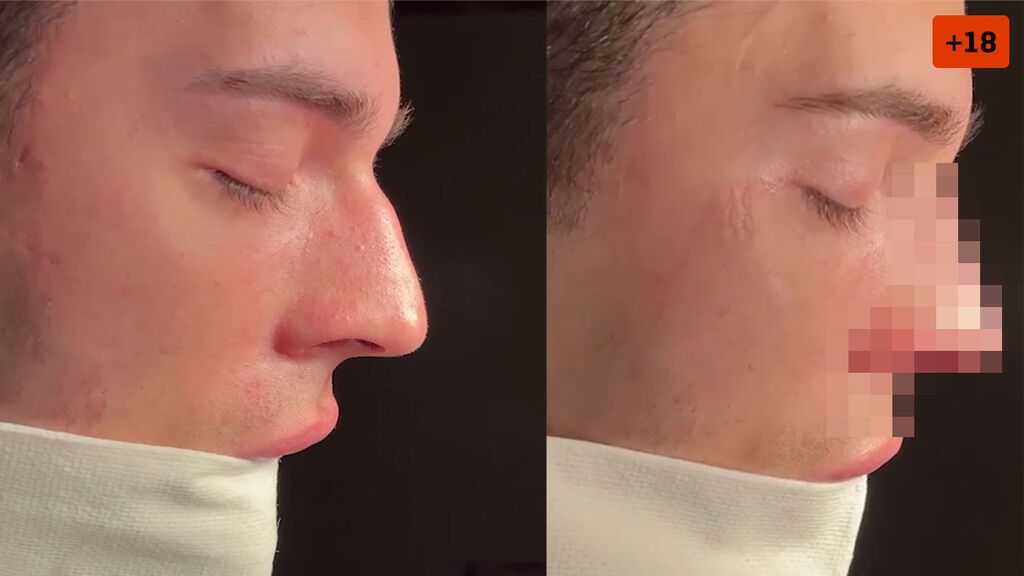 Jorge Cyrus enseña el resultado de su nariz tras someterse a una rinoplastia (2/2)