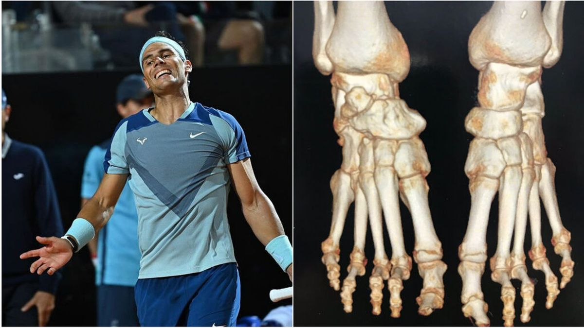 Müller-Weiss, el síndrome que sufre Rafa Nadal que le hace vivir en el dolor Müller-Weiss, el síndrome que sufre Rafa Nadal que le hace vivir en el dolor