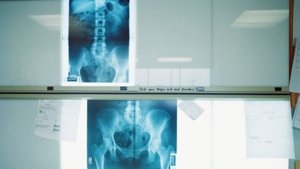 Muévete, la receta de los médicos a los pacientes con osteoporosis