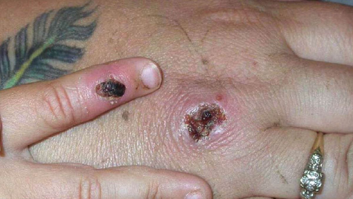 Síntomas de la viruela del mono en humanos: Reino Unido investiga 7 casos y avisa a la comunidad gay Síntomas de la viruela del mono en humanos: Reino Unido investiga 7 casos y avisa a la comunidad gay
