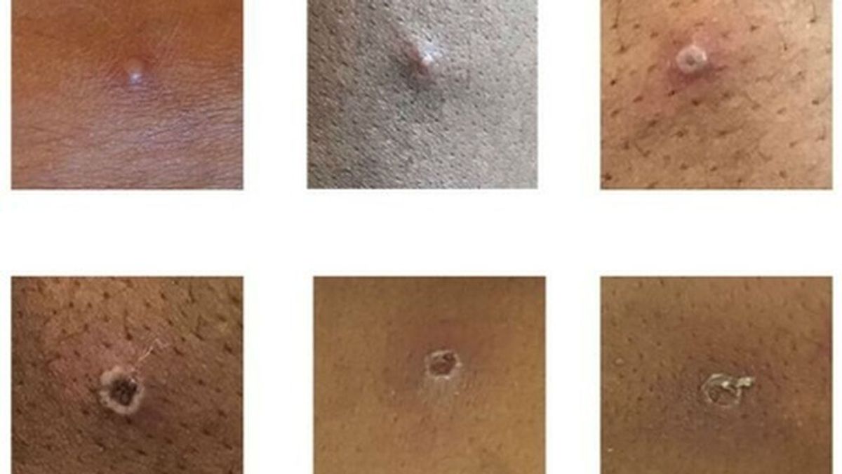 Reino Unido confirma 20 casos de viruela del mono y espera que el número continúe aumentando en los próximos días Reino Unido confirma 20 casos de viruela del mono y espera que el número continúe aumentando en los próximos días