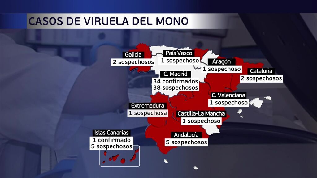 ¿Por qué España lidera el ranking de casos de viruela del mono en el mundo?