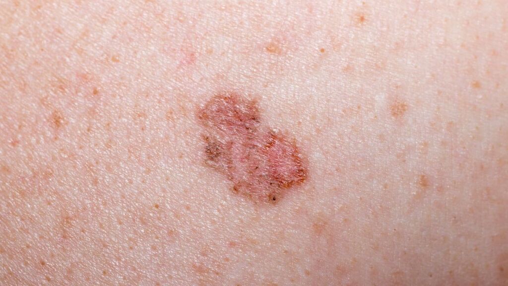 Día Mundial del melanoma: ¿Cuándo correr al dermatólogo?