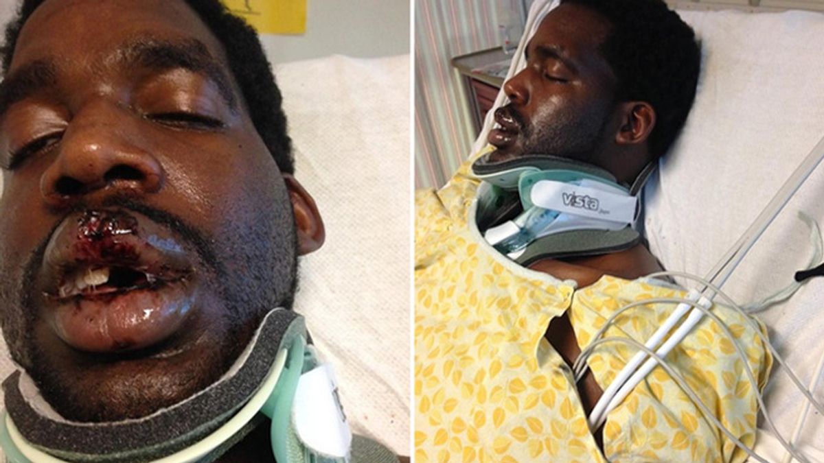 Un hombre se fractura el cuello tras explotarle un cigarro electrónico en la cara