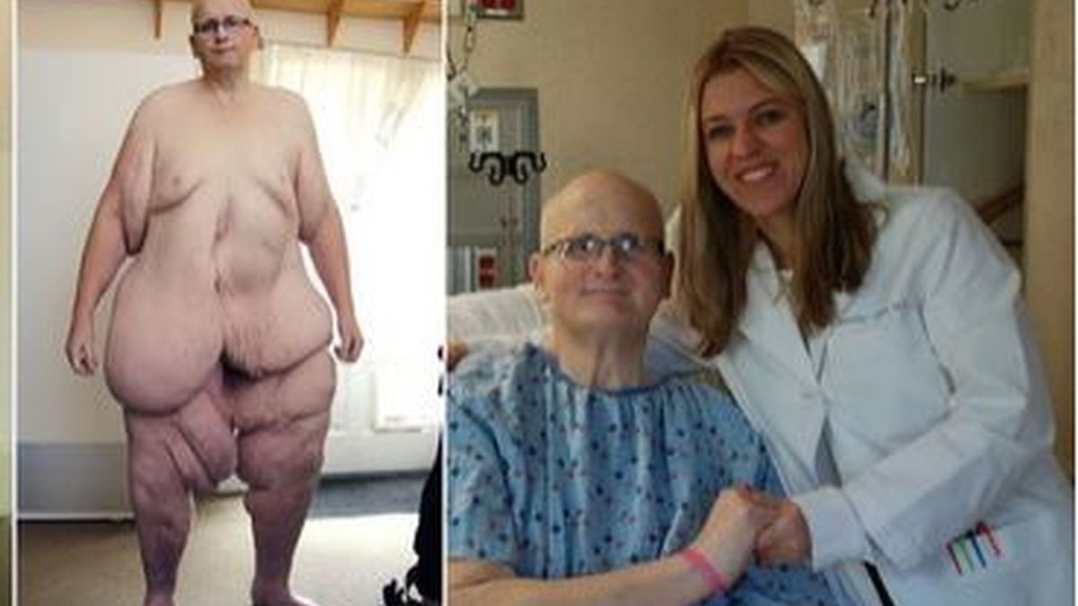 El exhombre más gordo del mundo vuelve a caminar tras eliminar la piel suelta de sus piernas