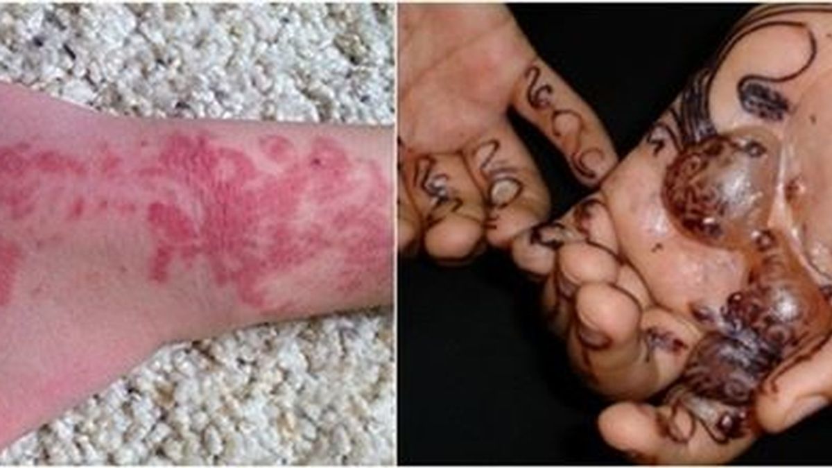 Los tatuajes de henna negra pueden producir reacciones alérgicas graves