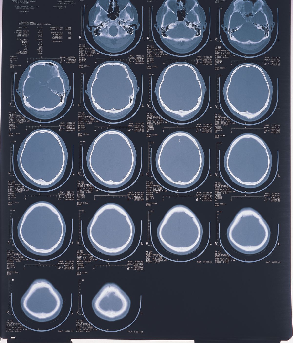 Radiografía de cerebro