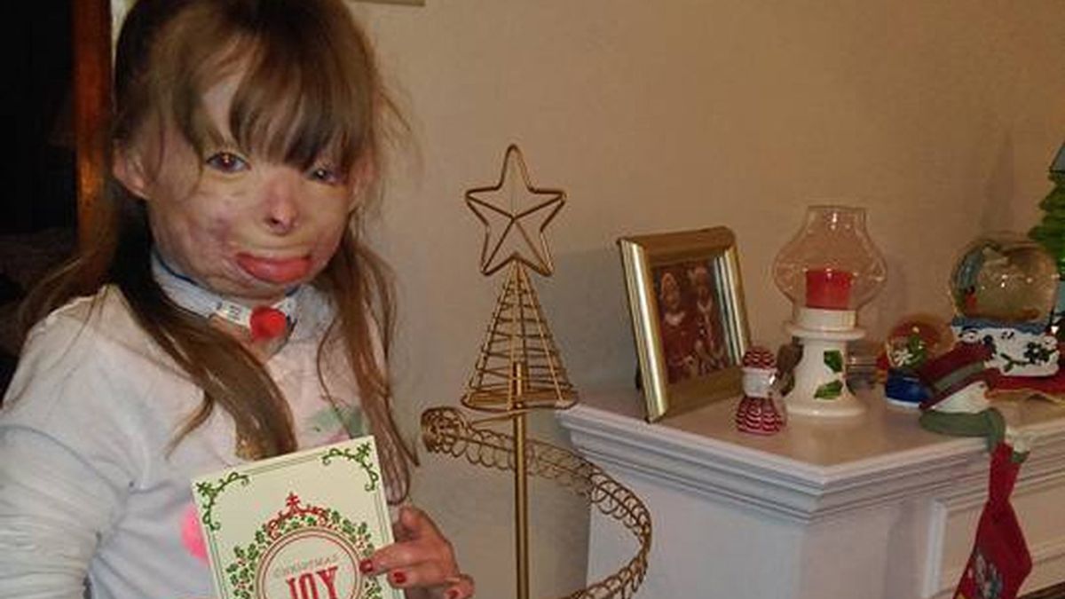 Una niña gravemente herida en el incendio de su casa sólo quiere ‘christmas’ esta Navidad