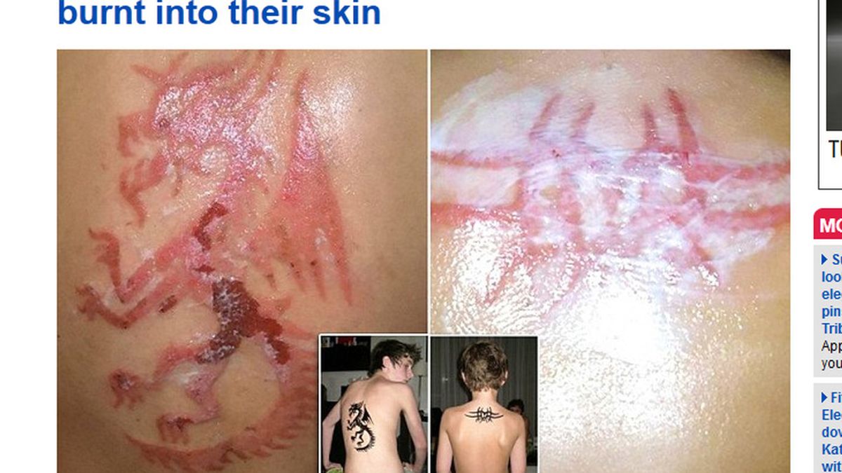 Quemaduras con tatuajes de henna