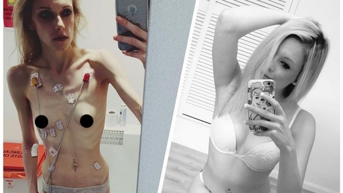 La increíble recuperación de una adolescente anoréxica que comía 20 calorías al día